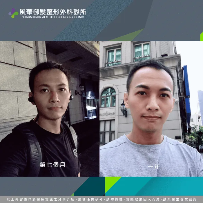 植髮7個月到1年-M型禿植髮