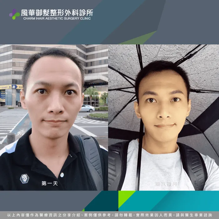 M型禿植髮-新竹植髮推薦