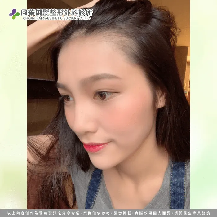 植髮後右側外觀-女性植髮