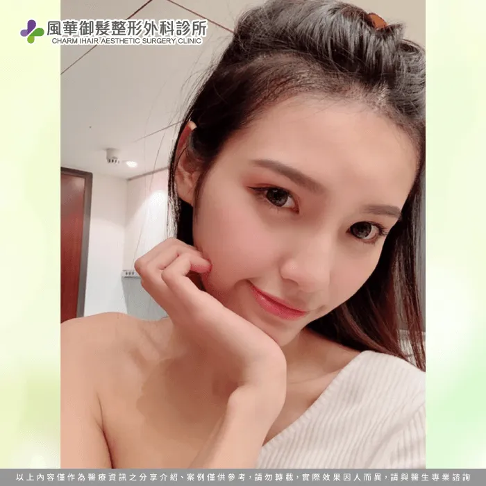 植髮後自拍-女性植髮