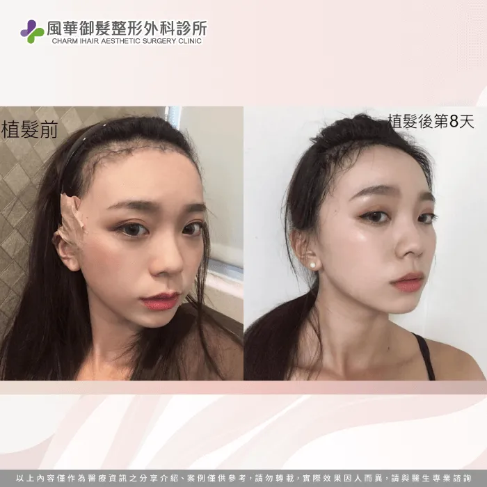 網美陳昭華植髮成效-女性植髮