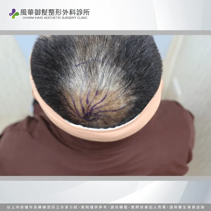 M先生頭皮檢測-地中海禿頭植髮