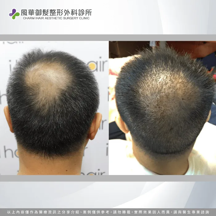 M先生頭頂部禿髮狀況-地中海禿頭植髮