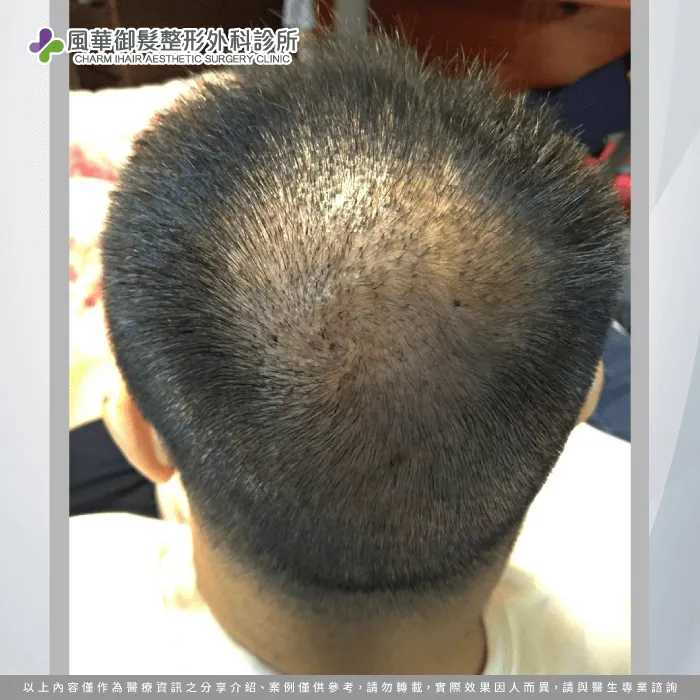 M先生地中海禿頭植髮狀況-地中海禿頭植髮