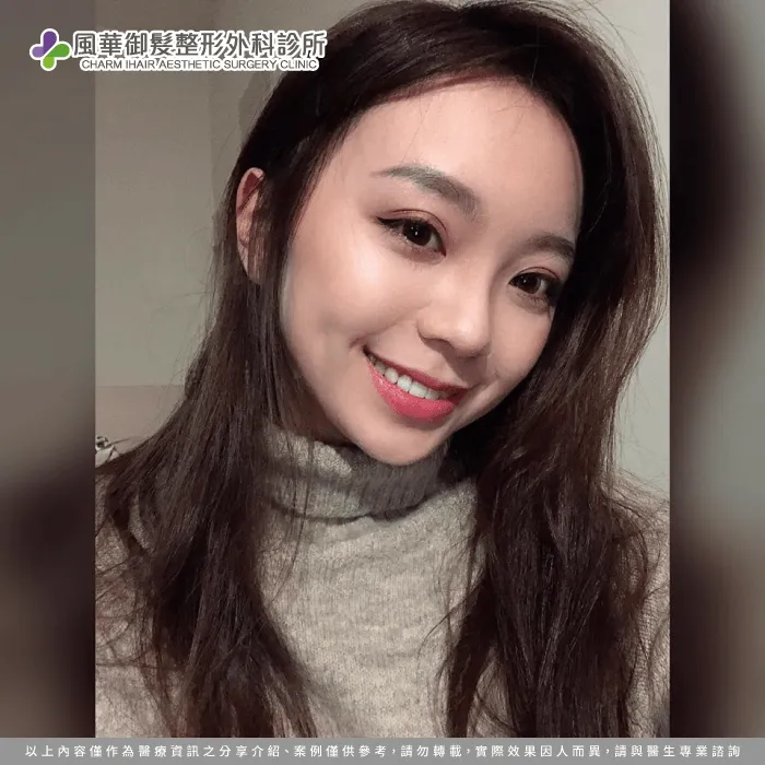 植髮後成效-新竹植髮推薦