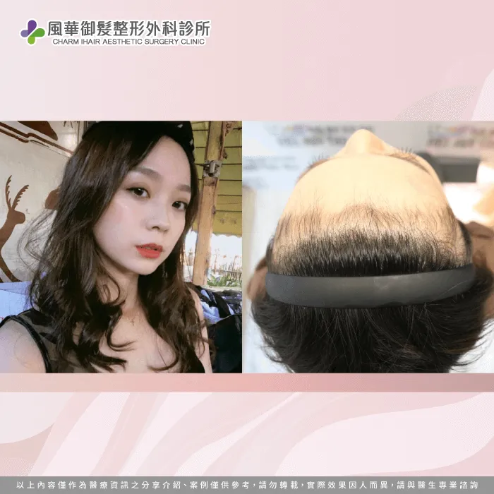 網美陳昭華髮際線重建-女性植髮