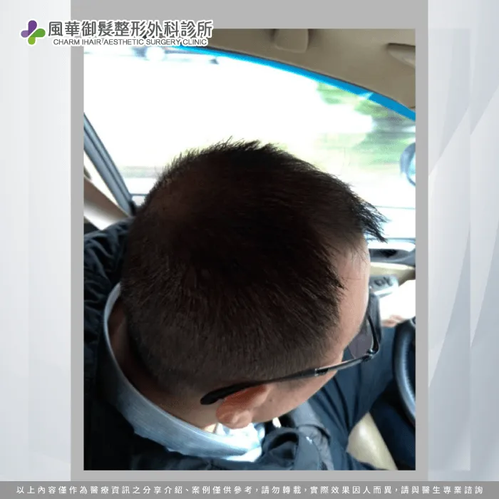 M先生植髮後成效-新竹植髮推薦