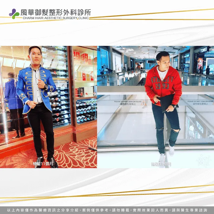 擺脫遮遮掩掩沒自信的生活,因為植髮重新開始自信生活! Y歌手植髮後11個月-新竹植髮推薦