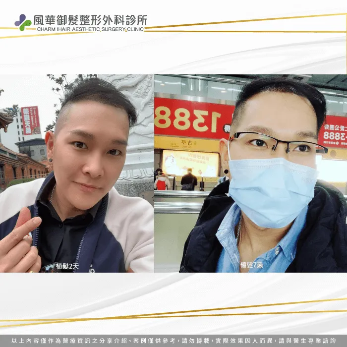 術後2-7天,成果看起來相當自然頭皮也沒有任何不適 Y歌手植髮後2天和7天-雄性禿植髮