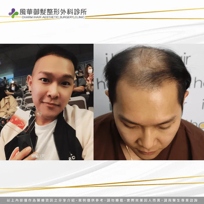 長期都戴著帽子演出的y歌手,在植髮前缺乏自信心 Y歌手禿髮狀況-雄性禿植髮