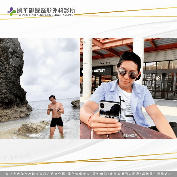 植髮過後9個月,頭頂秀髮開始變得茂密,拍照不需要喬角度了 Y歌手植髮後9個月-雄性禿植髮