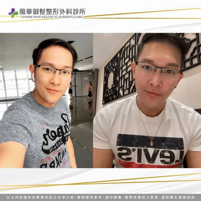 想要解決禿髮狀況的馬來西亞y歌手,透過ihair風華御髮診所重獲自信! Y歌手雄性禿植髮-雄性禿植髮