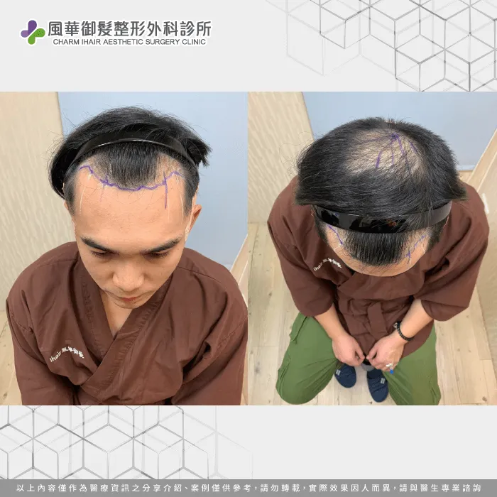 職業軍人S先生M型禿髮狀況-男性植髮