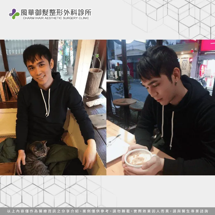 職業軍人S先生植髮手術後-男性植髮