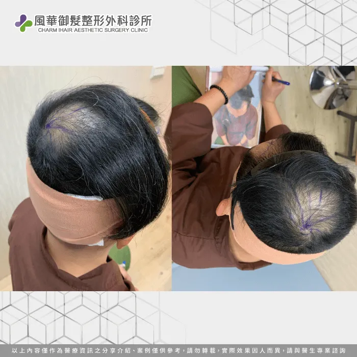 職業軍人S先生頭頂部禿髮狀況-男性植髮