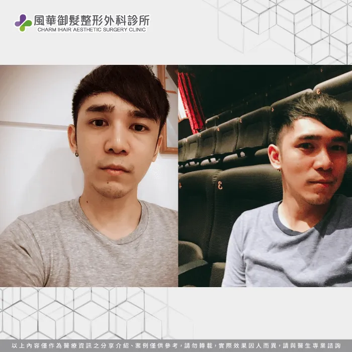 職業軍人S先生男性植髮體驗-男性植髮