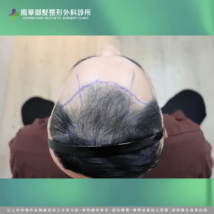 規劃植髮區域-FUE巨量植髮