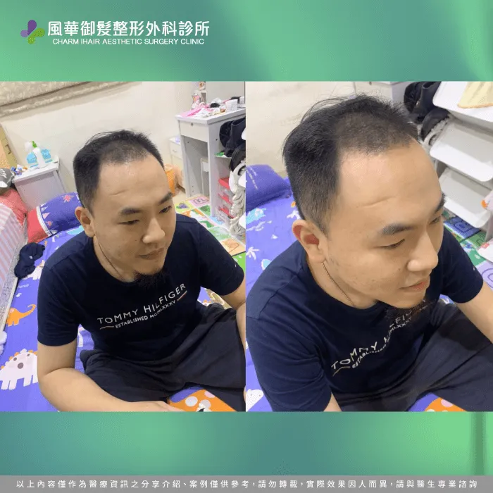植髮後髮量-FUE巨量植髮