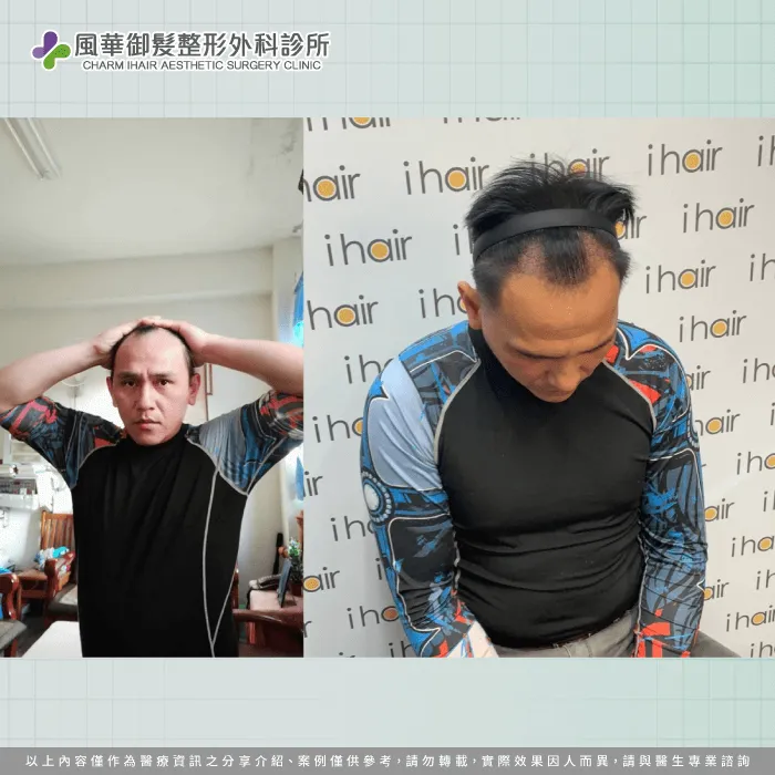 困擾F先生許久的M型禿髮情形,運用ihair風華御髮診所的植髮服務找回自信心 M型禿植髮-新竹植髮推薦