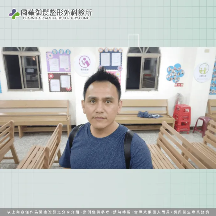 透過髮際線額角的填補植髮,讓外觀更加年輕 植髮後的外觀改變-FUE巨量植髮