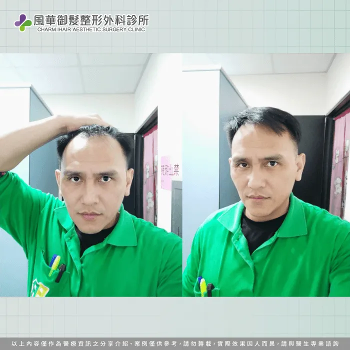 F先生想要透過植髮服務讓髮際線回歸,展現更多自信心 植髮後生長狀況-FUE巨量植髮