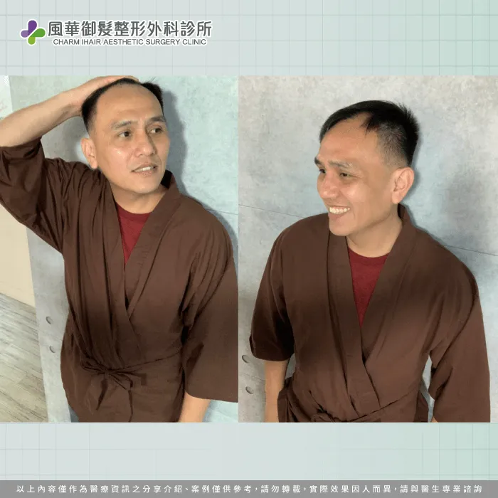 F先生在植髮前的額角明顯缺髮,透過諮詢後決定以巨量植髮為目標 FUE巨量植髮前-M型禿植髮