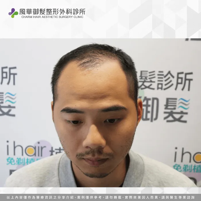 需要在鏡頭面前展現最好自己的Youtuber T先生,長期受雄性禿的困擾! T先生的雄性禿困擾-新竹植髮推薦