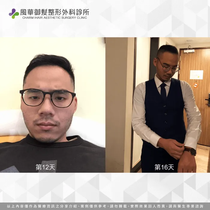 植髮後2周,豐厚的髮絲成效已慢慢的展現! 植髮後12天與16天-雄性禿植髮