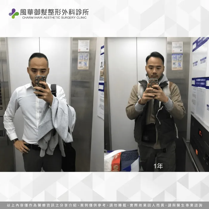 植髮後1年,明顯可以看出Youtuber T先生的外型改變! Youtuber T先生髮量稀疏的轉變-雄性禿植髮