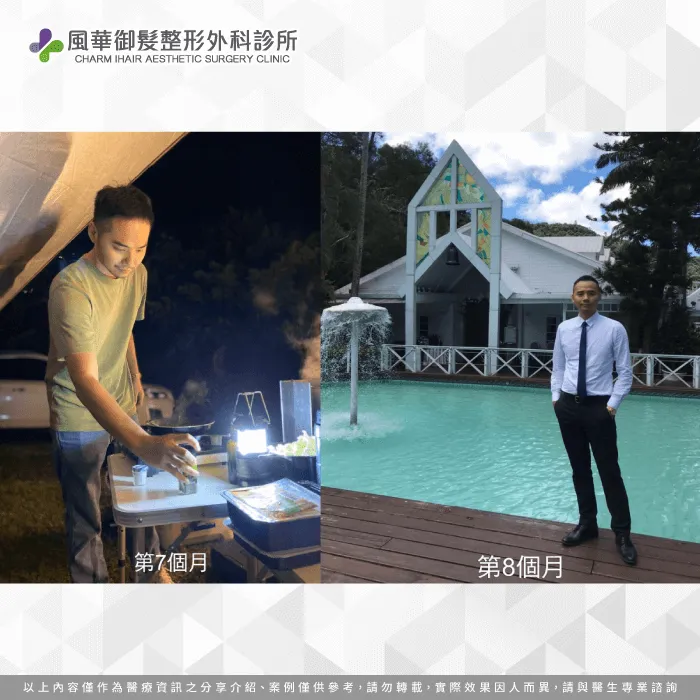 植髮後8個月,T先生明顯感受到植髮的效果 植髮後8個月-雄性禿植髮