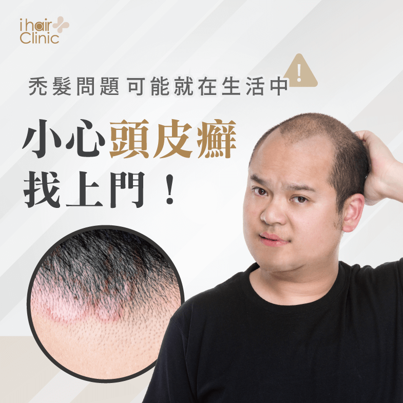 頭皮癬禿頭怎麼辦-新竹植髮診所推薦