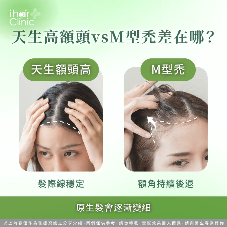 高額頭還是M型禿?髮際線差異解析 高額、M型禿差異比較-M型禿植髮