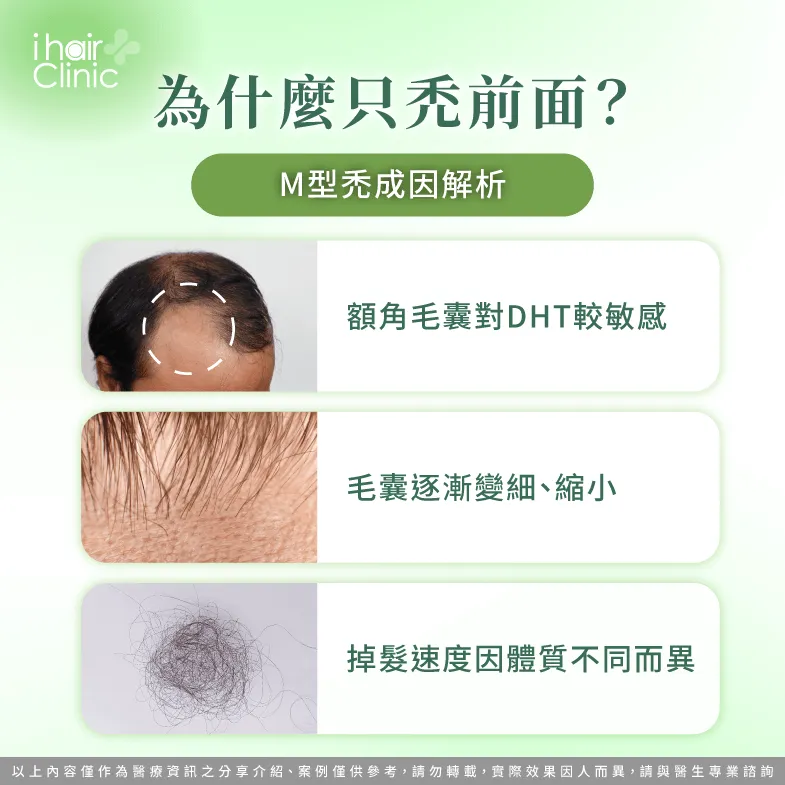為什麼只禿前面?M型禿成因與DHT解析 M型禿原因-M型禿植髮推薦