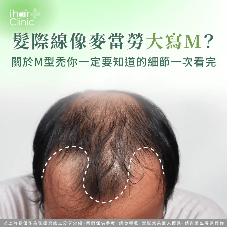 髮際線像M字?M型禿重點一次解析 髮際線M字-M型禿植髮診所