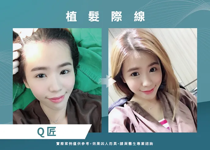 女性髮際線植髮推薦-高雄植髮際線