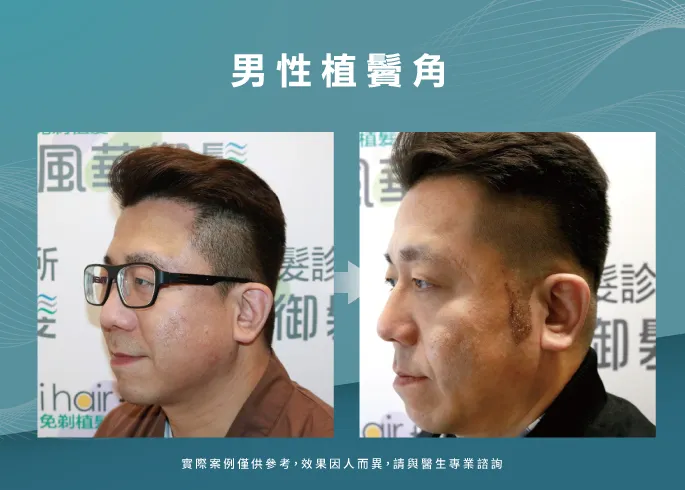 男性植鬢角見證-高雄植鬢角推薦