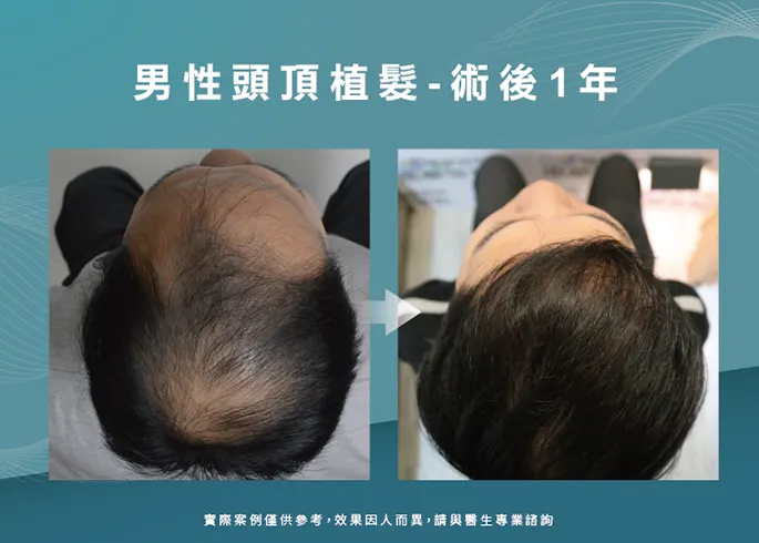 男性頭頂部植髮-高雄植髮診所推薦