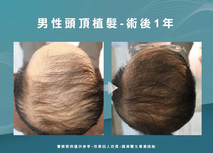 男性頭頂部植髮-高雄植髮診所推薦
