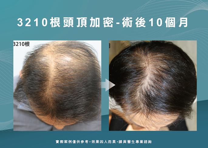 男性頭頂部植髮-高雄植髮診所推薦