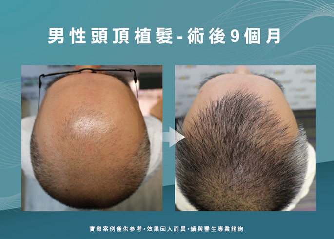 男性頭頂部植髮-高雄植髮診所推薦