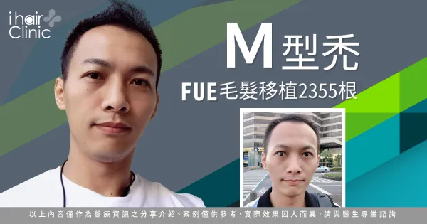 FUE植髮-高雄植髮推薦