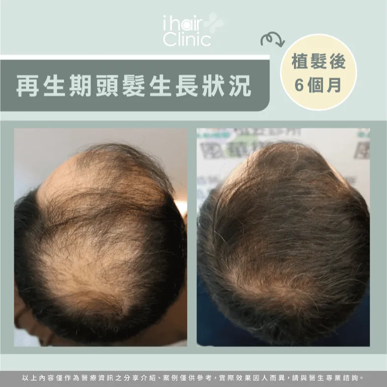 再生期頭髮生長狀況-植髮後多久長頭髮
