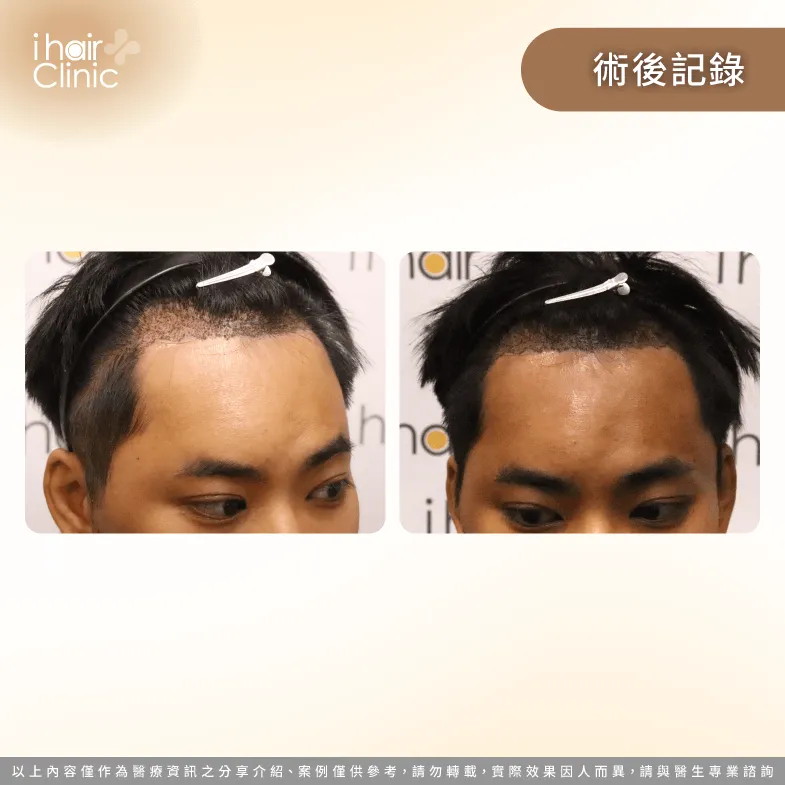 植髮手術完成當天紀錄,種植2300根毛囊,成功植入髮際線 手術剛完成-M型禿植髮