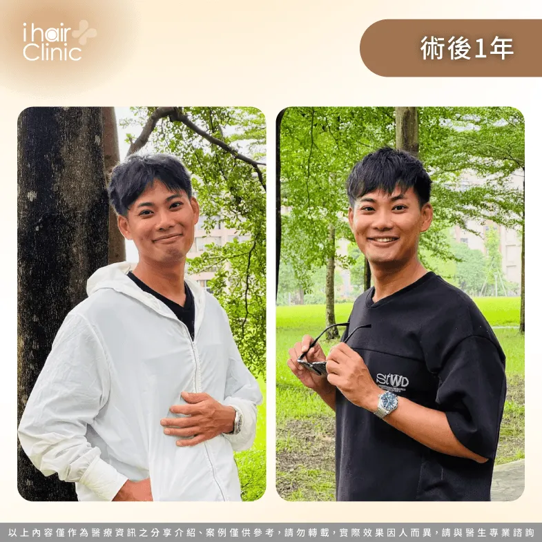 植髮1年成果分享,M型禿改善後找回自信笑容 術後1年-M型禿植髮