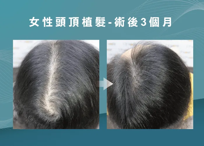 採用頭頂植髮技術化解分線禿困擾，讓頂上的秀髮更茂密