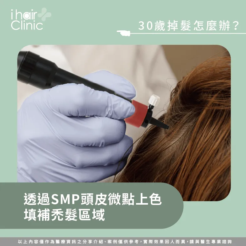 以LSMP為頭皮上色-30歲禿頭怎麼辦