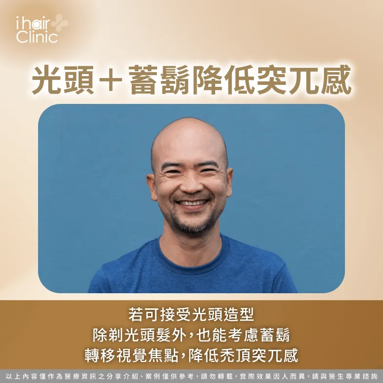 禿頂依舊可考慮剃光,但可搭配蓄鬍並修剪不同鬍形,降低禿頂突兀感 理光頭並搭配蓄鬍造型-禿頭 剃光