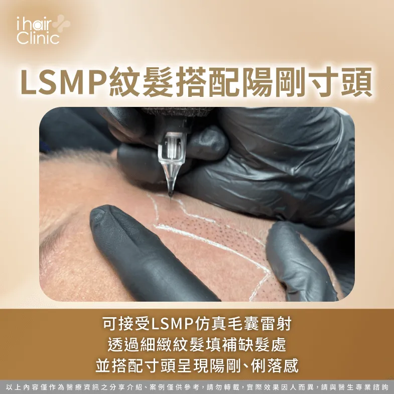 可修剪帥氣寸頭,並搭配LSMP紋髮填補額角缺髮,營造十足陽剛、俐落感 LSMP紋髮可搭配帥氣寸頭-禿頭 剃光頭