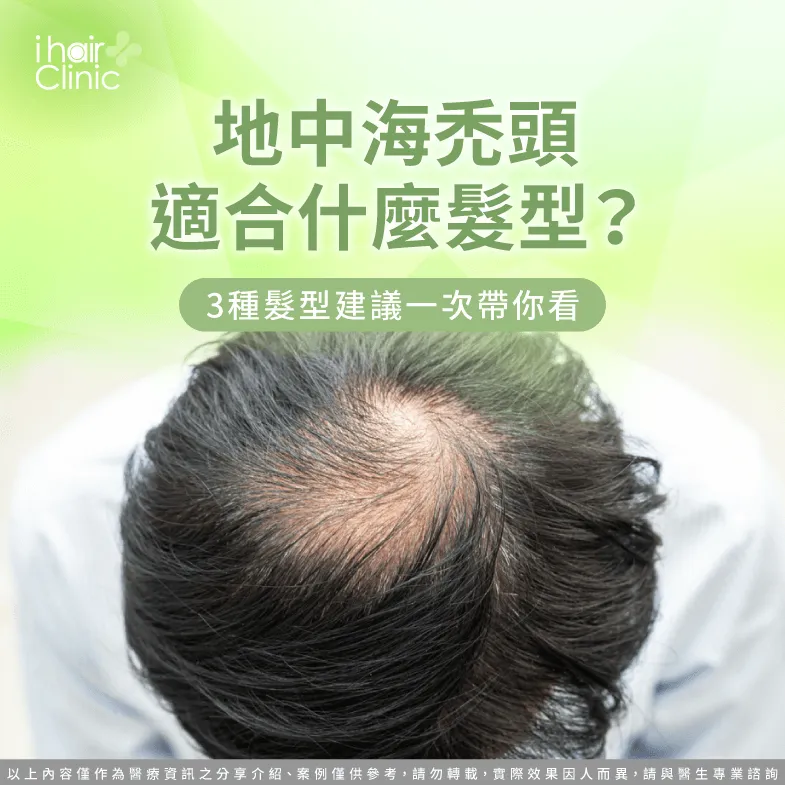 地中海禿頭適合什麼髮型?3種合適髮型建議一次推薦 地中海禿頭適合的3種髮型一次看-地中海禿頭 髮型