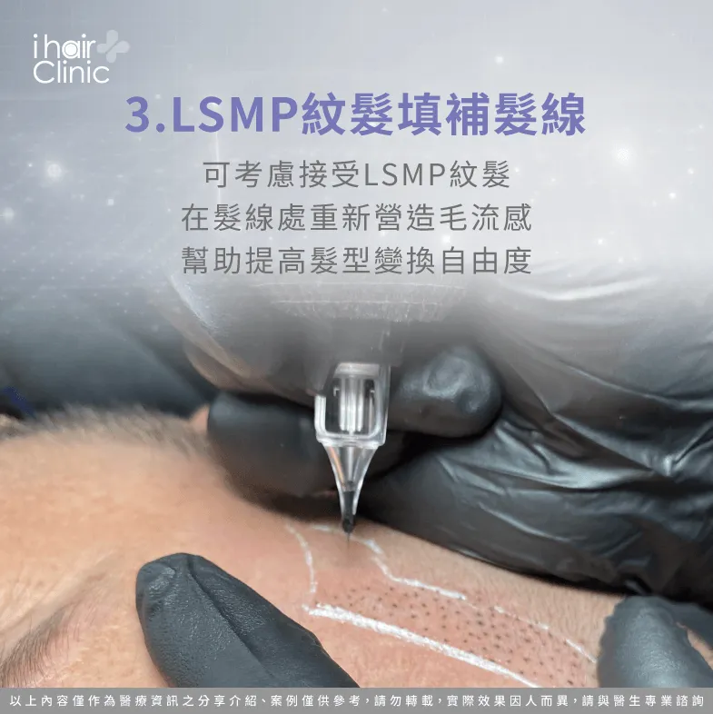 接受LSMP紋髮填補髮際線空洞